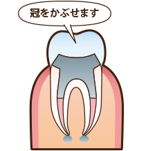 根管治療の流れ 6