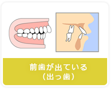 前歯が出ている（出っ歯）