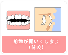 前歯が開いてしまう（開咬）