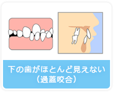 下の歯がほとんど見えない（過蓋咬合）