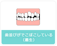 歯並びがでこぼこしている（叢生）